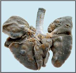 肺寄生虫病