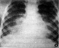 肺并殖吸虫病