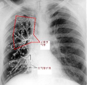 小儿支气管肺发育不全