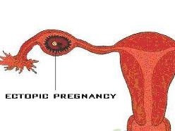 持续性输卵管妊娠