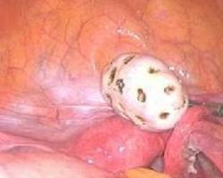 卵巢成熟畸胎瘤