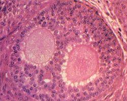 卵巢纤维组织来源肿瘤
