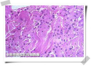 外阴颗粒性肌母细胞瘤