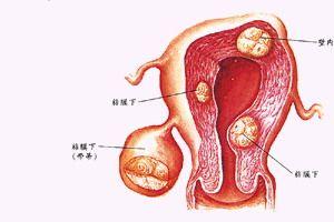 阴道平滑肌肉瘤