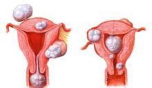 阴道子宫内膜间质肉瘤