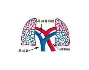 肺动静脉瘤