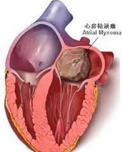 心脏横纹肌瘤