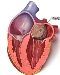 心脏黏液瘤