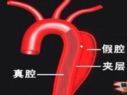 胸主动脉瘤