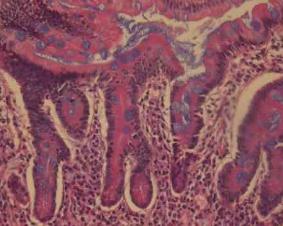 肺嗜酸细胞组织细胞增生症