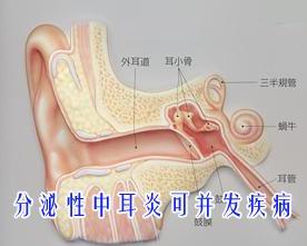 分泌性中耳炎