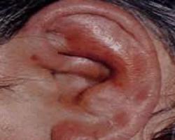 化脓性耳廓软骨膜炎