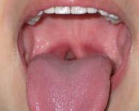 慢性舌扁桃体炎
