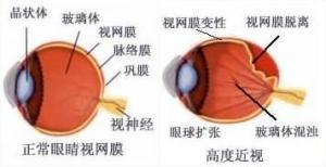 变性近视的脉络膜萎缩
