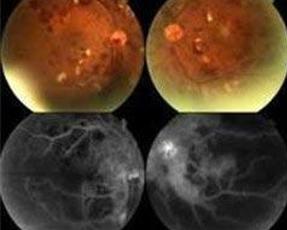 放射性视网膜病变