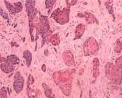 角膜鳞状细胞癌