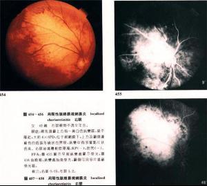 视网膜后膜