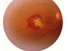 视网膜母细胞瘤