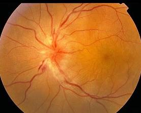 视网膜血管炎