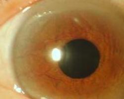 新生血管性青光眼