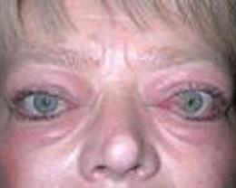 眼眶炎性假瘤