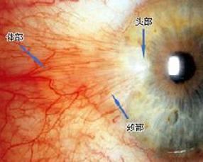 眼外肌广泛纤维化综合征