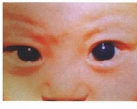 原发性婴幼儿型青光眼