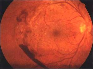 增生性玻璃体视网膜病变