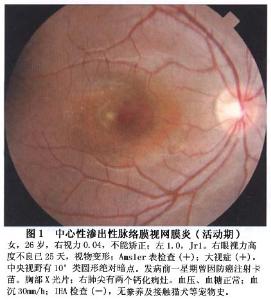 中心性渗出性脉络膜视网膜病变