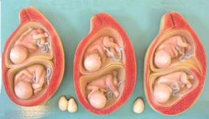 双胎妊娠双胎输血综合征